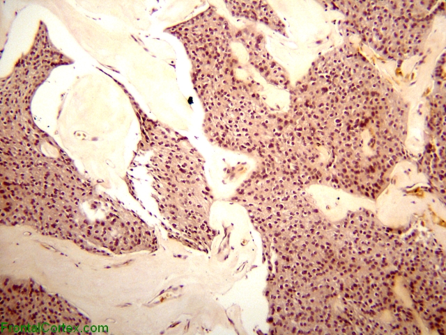 Myxopapillary ependymoma, mucicarmine histochemical staining x 40